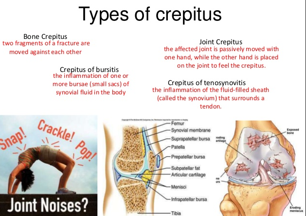 chart of crepitus